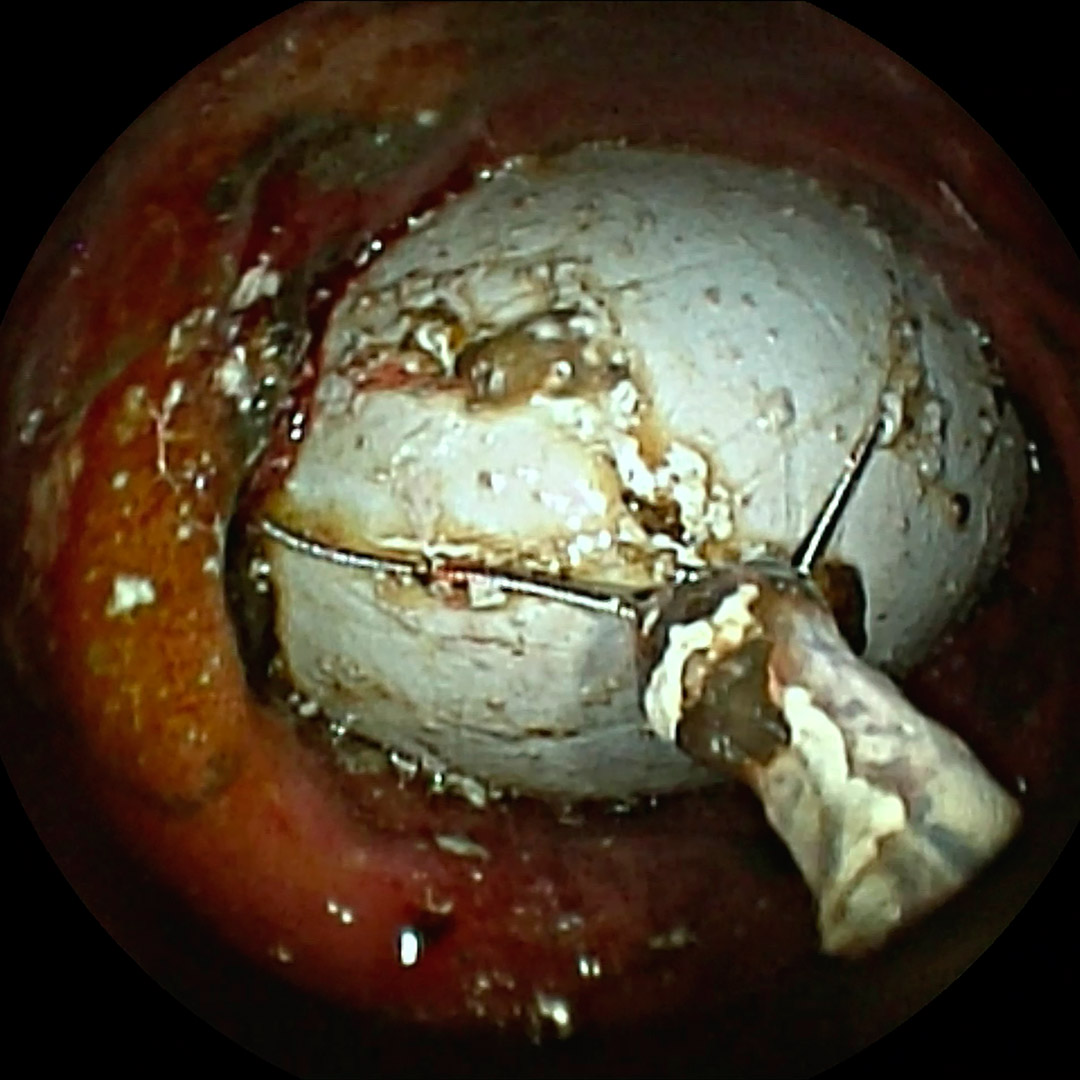 cuerpo extraño intestinal