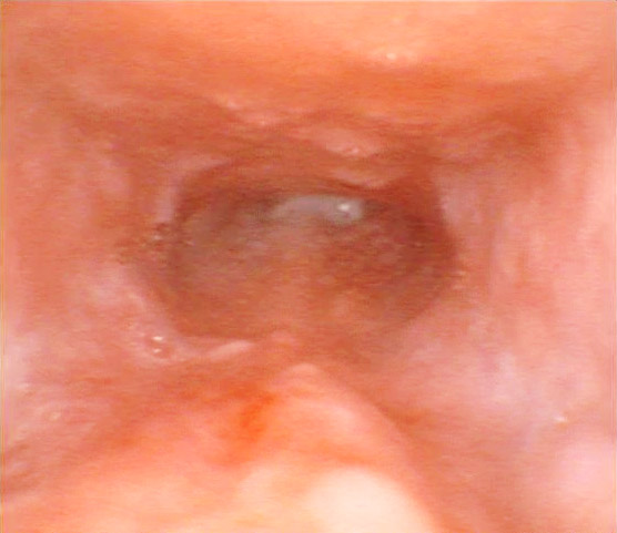 Nasofaringitis aguda